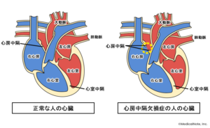 心房中隔欠損症とはのイメージ