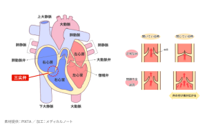 僧帽弁閉鎖不全症の原因、症状、診断、治療についての完全ガイドのイメージ