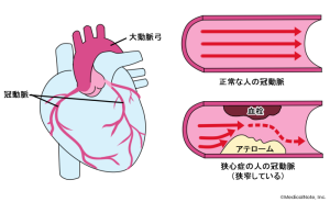 狭心症とはのイメージ