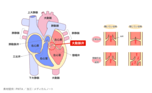 大動脈弁閉鎖不全症とはのイメージ