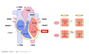 僧帽弁狭窄症とはのイメージ