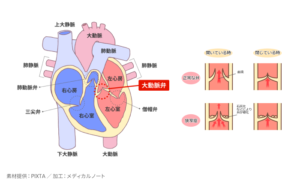 大動脈弁狭窄症とは？原因・治療方法を解説のイメージ