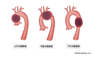 大動脈瘤とはのイメージ