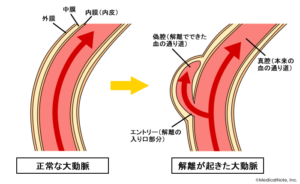 大動脈解離とはのイメージ