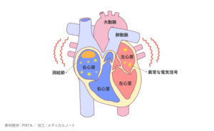 心房細動とはのイメージ