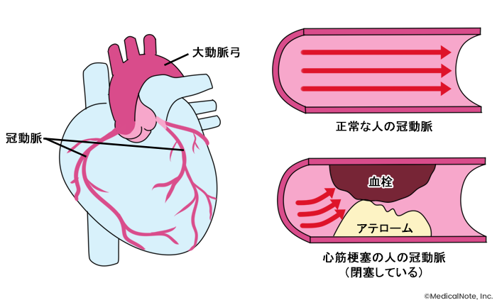 心筋梗塞とはのイメージ